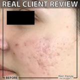Derma Roller 0.5mm